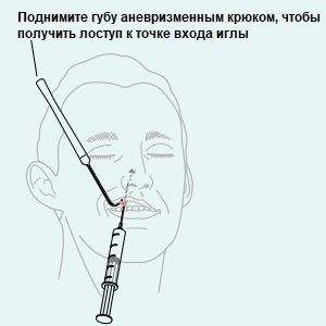 Восстановление мягких тканей носа с помощью Feature Builder, рисунок 5, бальзамирование и подготовка к прощанию истощенных тел, Tanatoservice