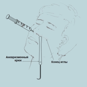 Восстановление мягких тканей щек с помощью Feature Builder, рисунок 4, бальзамирование и подготовка к прощанию истощенных тел, Tanatoservice