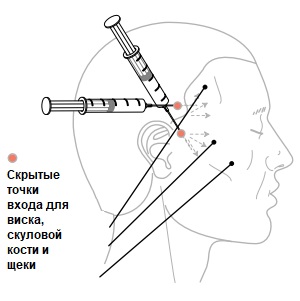 Восстановление висков с помощью Feature Builder, рисунок 1, бальзамирование и подготовка к прощанию истощенных тел, Tanatoservice
