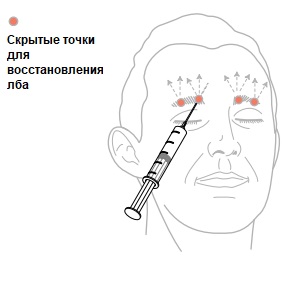 Восстановление мягких тканей лба с помощью Feature Builder, рисунок 2, бальзамирование и подготовка к прощанию истощенных тел, Tanatoservice