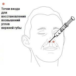 Восстановление мягких тканей губ с помощью Feature Builder, рисунок 6, бальзамирование и подготовка к прощанию истощенных тел, Tanatoservice